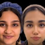 10 نکته کلیدی پیش از جراحی بینی گوشتی